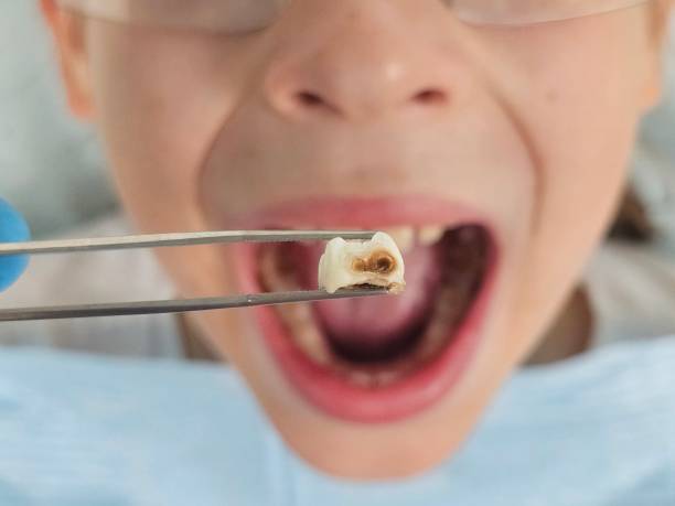 Best Cracked Tooth Emergency Dentist  in Ames, TX